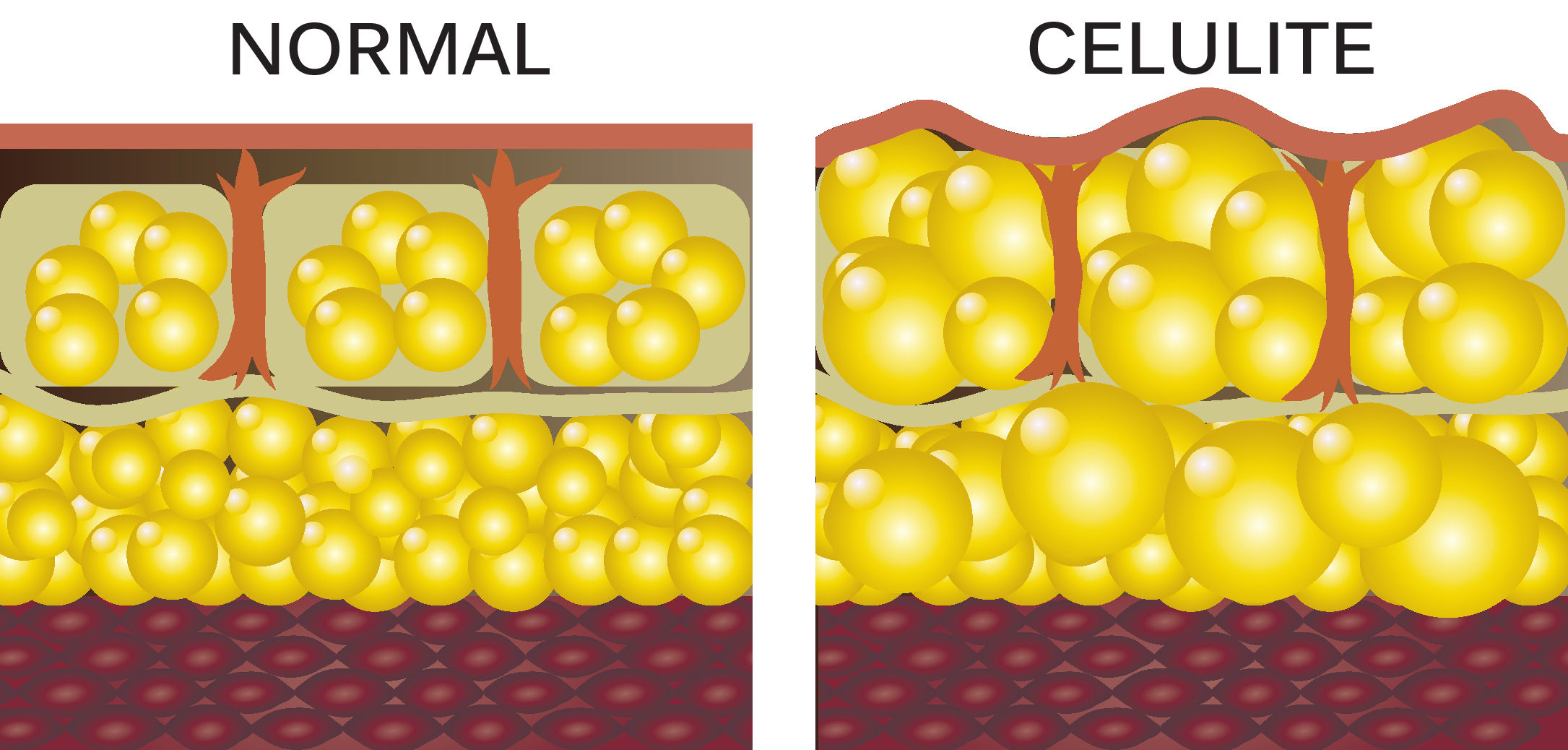 Celulite: o que \u00e9? E como ela surge? \u2013 Bioflora